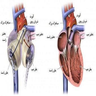 نمونه عکس تحقیق در مورد قلب مصنوعی